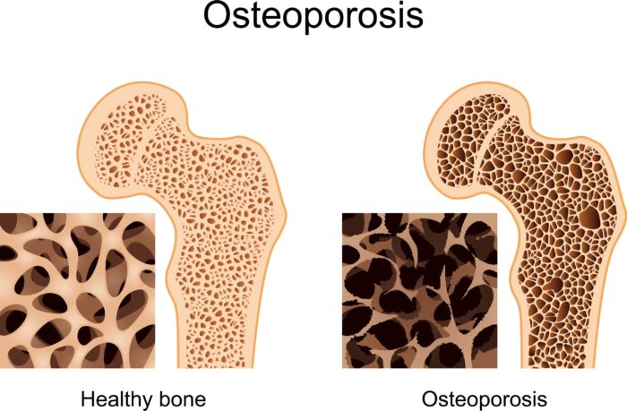 Type 1 Research - Diabetes & Osteoporosis - Diabetes Ireland : Diabetes ...